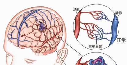 儿童脑出血最大元凶——脑动静脉畸形（AVM）