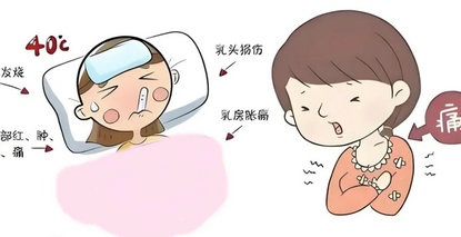 新手妈妈的“甜蜜负担”-- 哺乳期乳腺炎