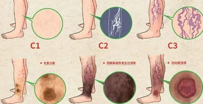 静脉发出的求救信号：一张血管超声报告藏着哪些秘密？