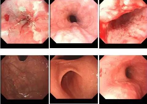 食道溃疡的症状图片图片