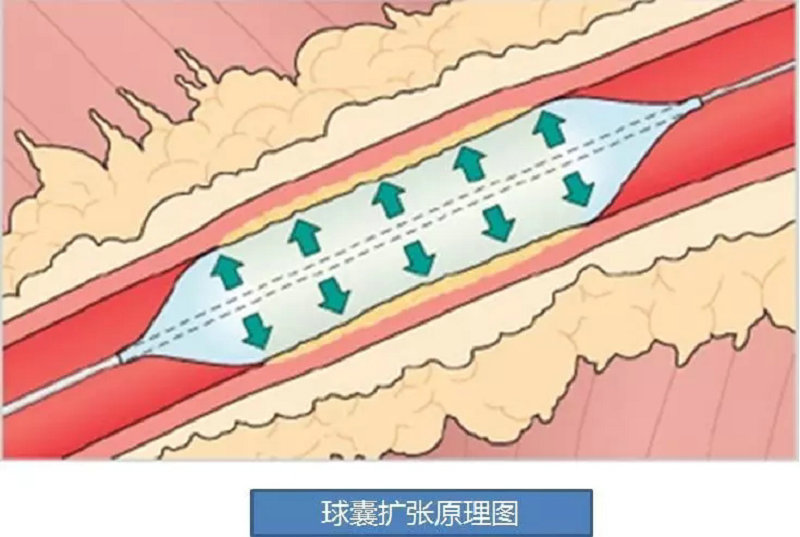 如何爱你,我的瘘?"系列科普之动静脉瘘失功后的处理