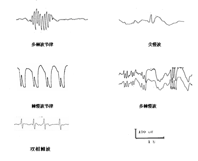 尖棘波图片