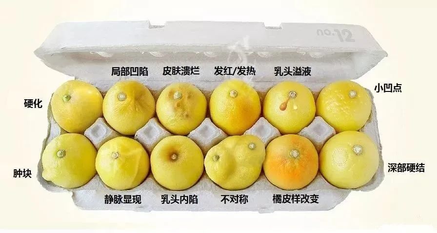 乳腺癌乳头回缩图片图片