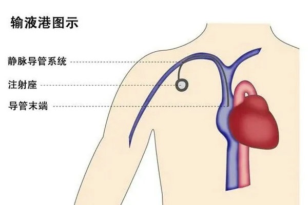 输液港原理图示图片