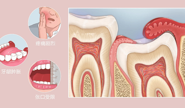 牙龈盲袋是什么图片