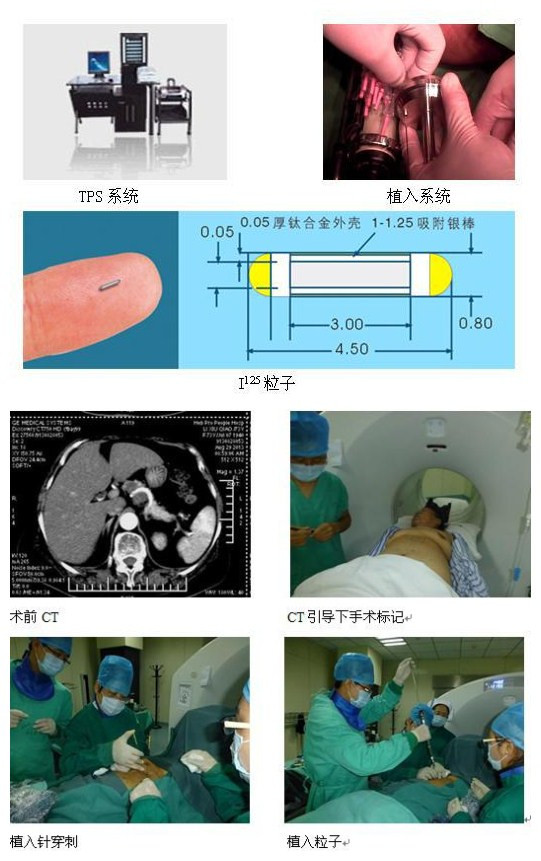 放射性粒子植入