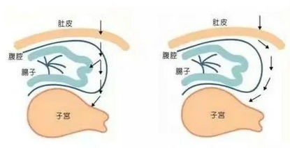 你了解腹膜外剖宫产吗？