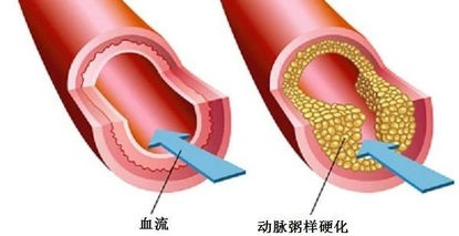 别让青年卒中“卒”不及防