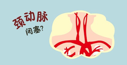 颈动脉完全闭塞还有救吗？69岁老人用亲身经历回答
