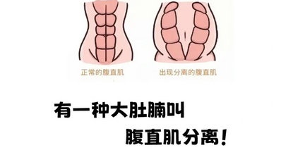 腹直肌分离修复必看！科学认知与康复指南！