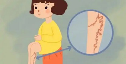 夏季告别蚯蚓腿全攻略