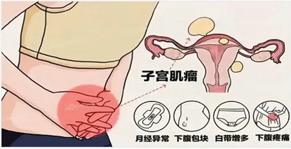 子宫保卫战｜一根“针” 融化烦恼