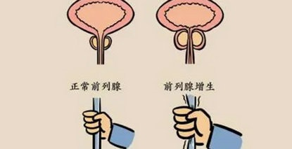 晚上总起夜？警惕这个 “报警信号”