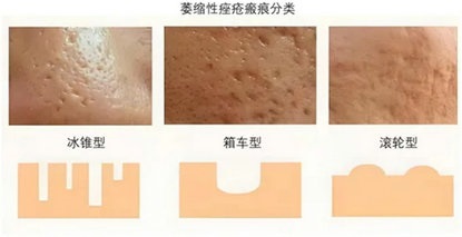 脸上的“月球表面”有救了！痤疮瘢痕修复全攻略来了！