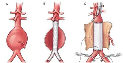 肚子摸到“包”在跳？小心爆了！