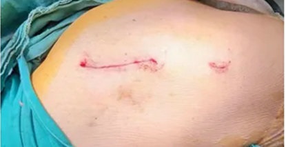 国际先进技术丨八旬老人髋部骨折，术后次日即可行走