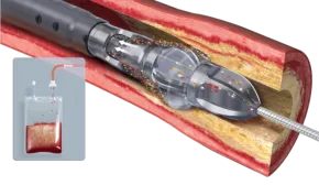 七旬老人告别行动困扰，微创手术打通“生命通道”