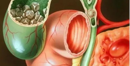 免“T管”，恢复快丨微创取石新选择