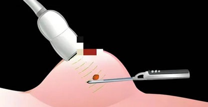 结节切除不留“痕”：乳腺微创旋切，守护你的美